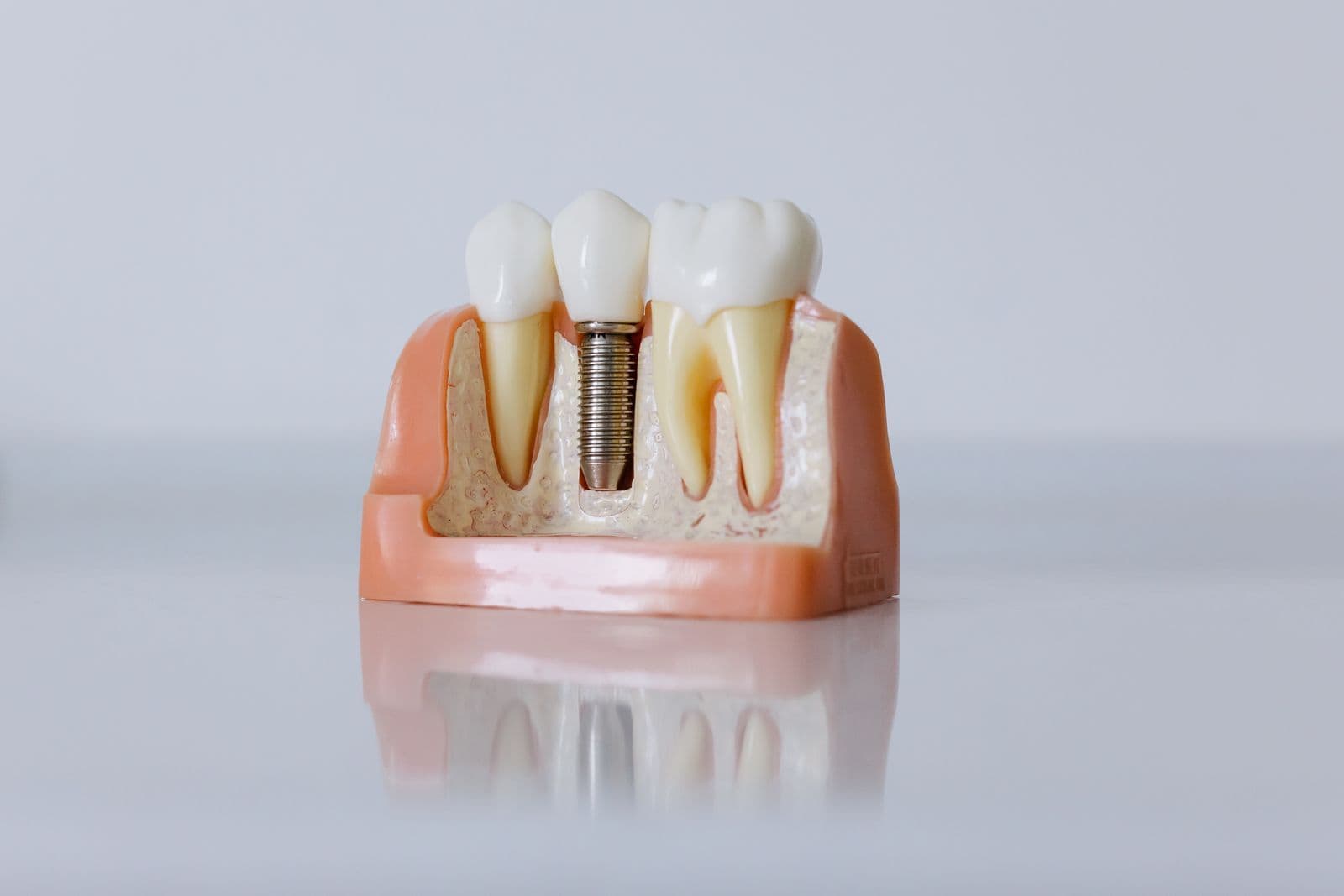 Cut-away model of a dental implant between natural teeth